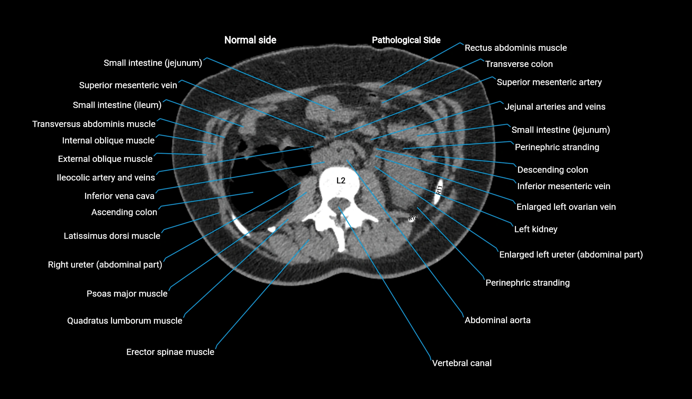 CT KUB axial cross sectional anatomy  radiology image -img-00201-00059.webp